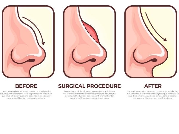 open-and-closed-rhinoplasty-scar