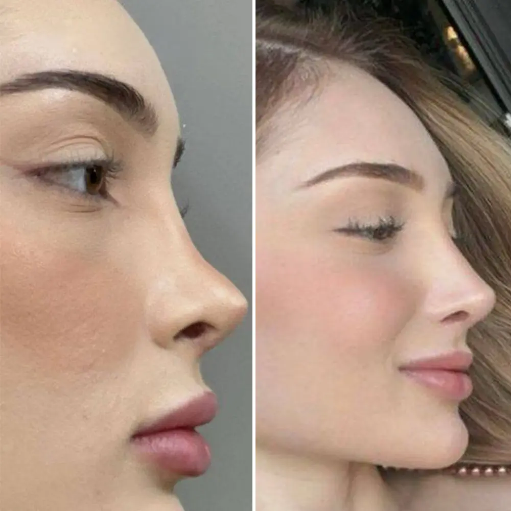 Revision rhinoplasty result - Sarah