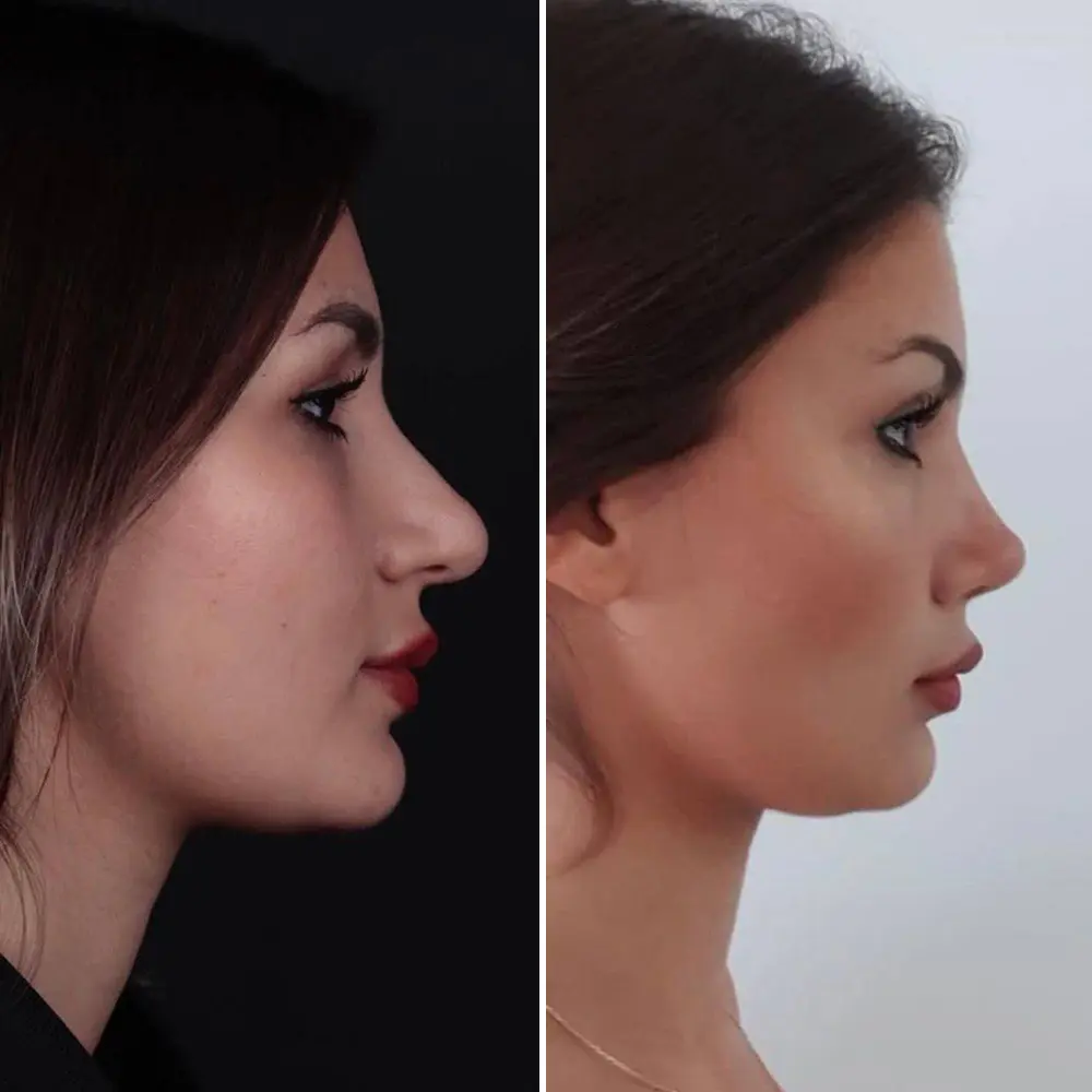 Revision rhinoplasty result - James