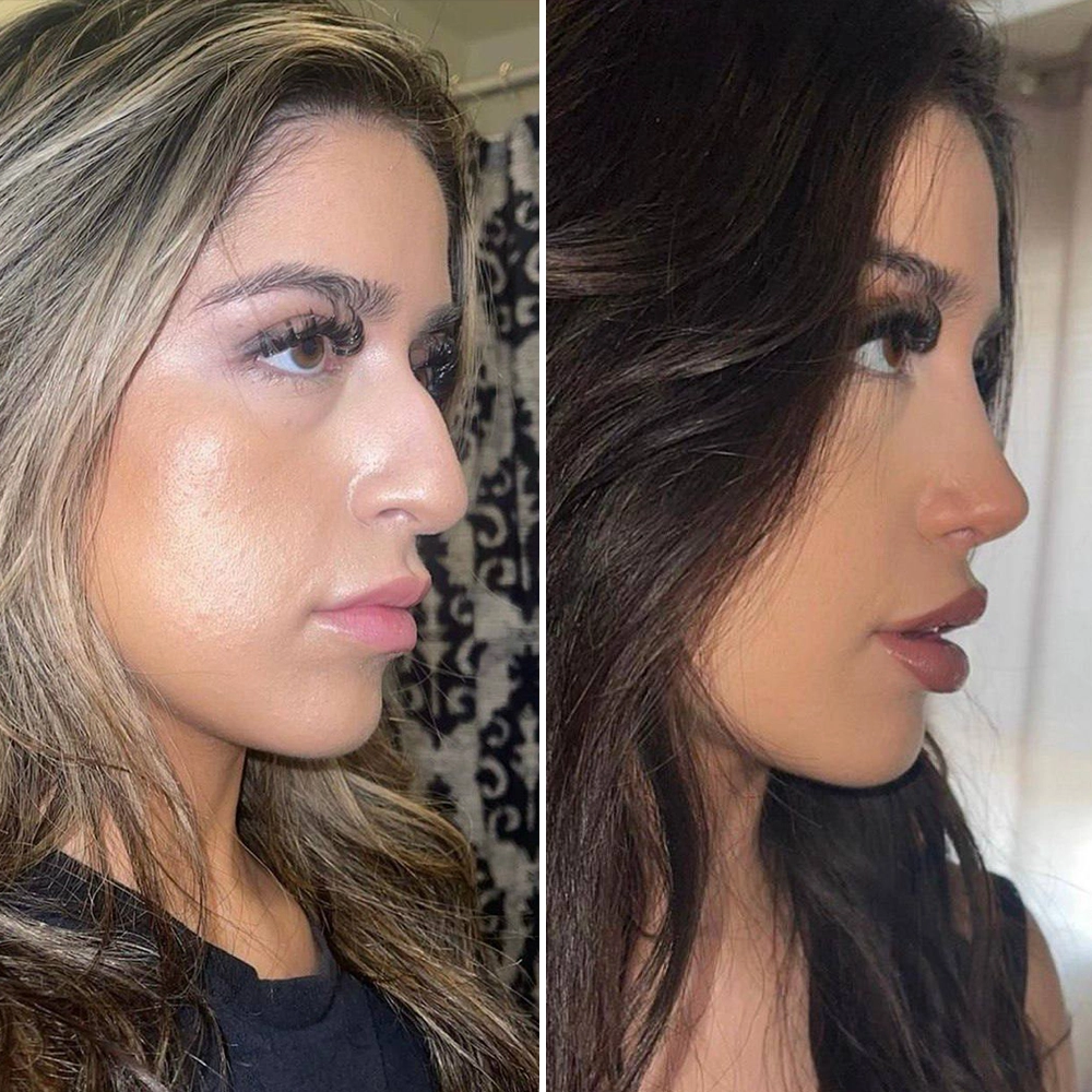 Revision rhinoplasty result - Emma