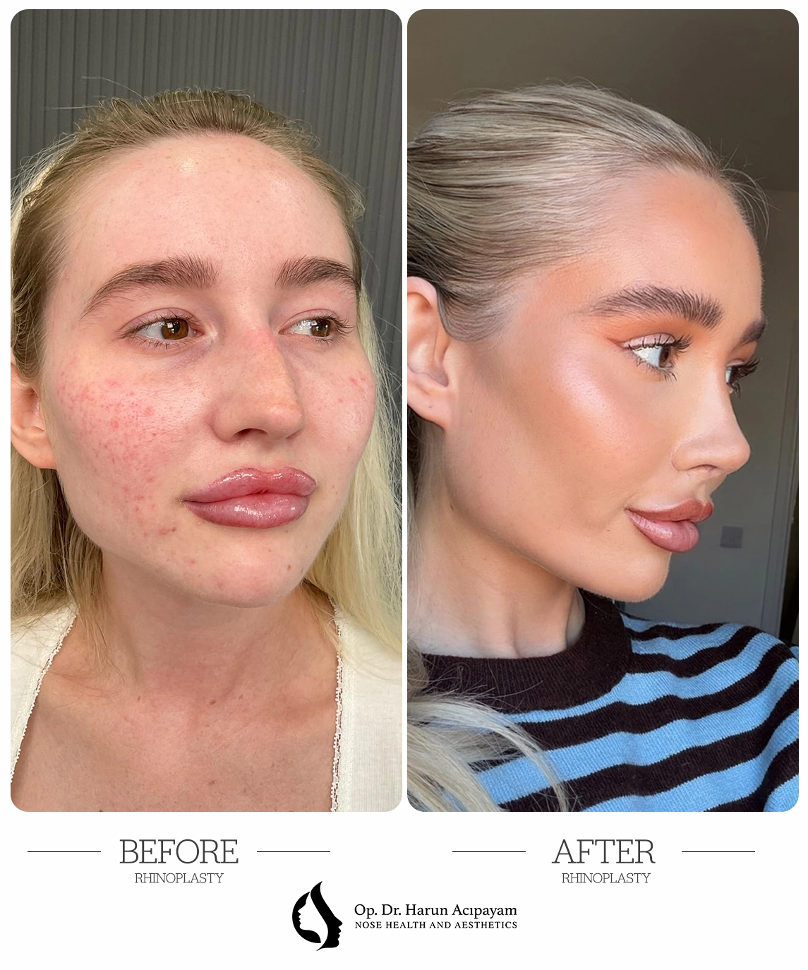 Barbie nose rhinoplasty case study, before and after profile view showing scooped bridge and lifted tip – Dr. Harun Acıpayam