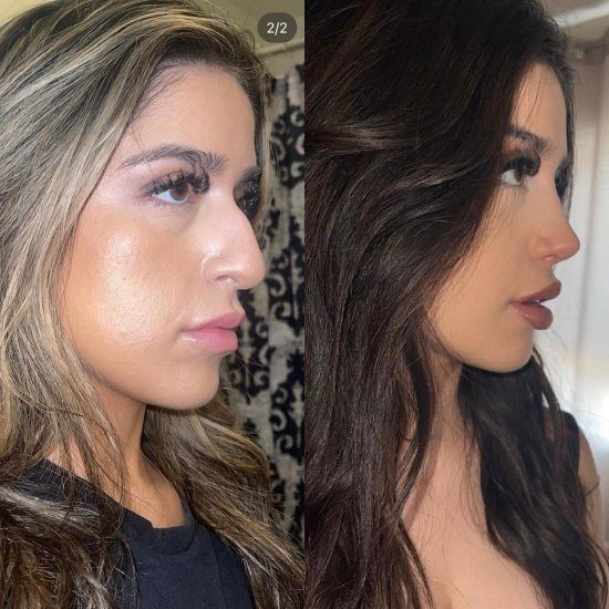 before after rhinoplasty